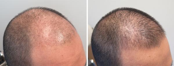 ALOPEXY 5% minoxidil pre mužov 3x60 ml (3 mesačná kúra) 1